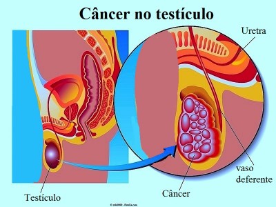Câncer nos testículos, tumor
