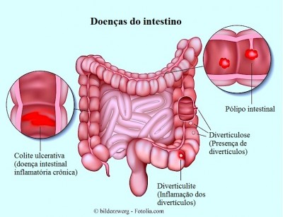 Polipo intestinal,Colite ulcerativa,doencas do intestino,diverticulite,diverticulose