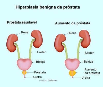 Inflamação da próstata