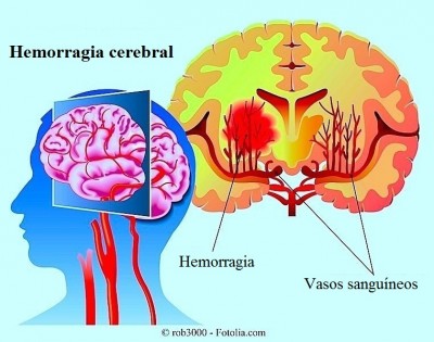 Hemorragia cerebral