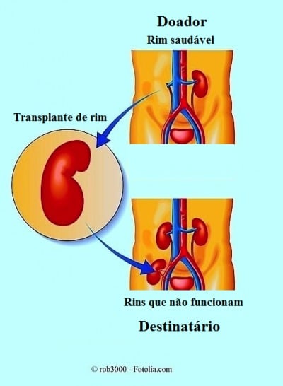 transplante de rim, renal