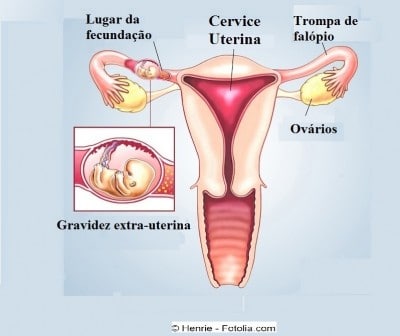 Gravidez ectópica, ovário, útero, feto