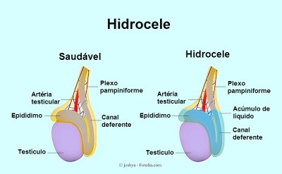 Hidrocele