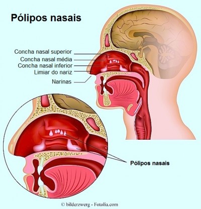 pólipos nasais,nariz