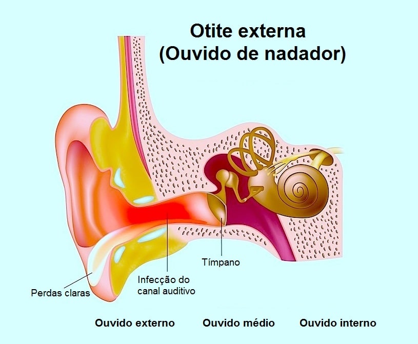 Воспаление внутреннего уха лечение. Воспаление уха наружный отит.