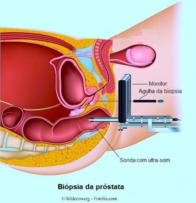 Biópsia da próstata,ecografia transretal