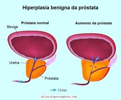 Prostatite aguda ou crônica