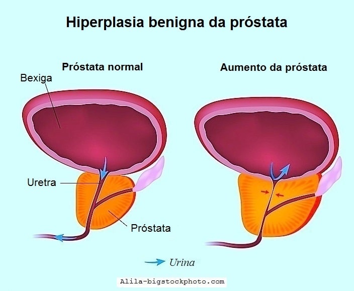 Hiperplasia ejemplos