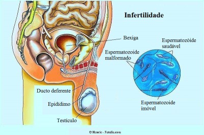 Órgãos genitais masculinos,espermatozóides,saudavéis,malformado