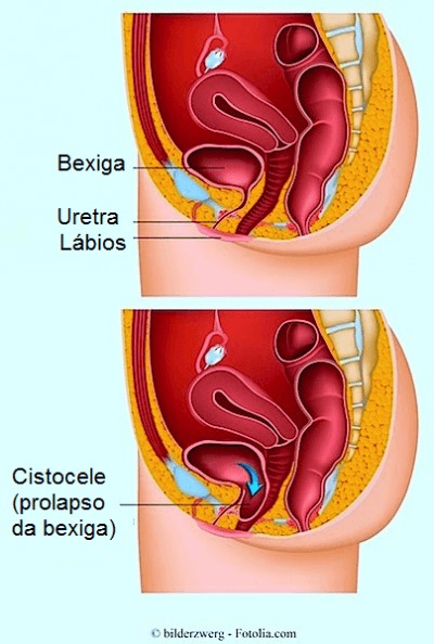 Prolapso da bexiga,anatomia,útero,vagina,uretra