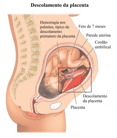 destacamento,da,placenta