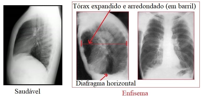 enfisema,radiografia,Diafragma horizontal,tórax expandido