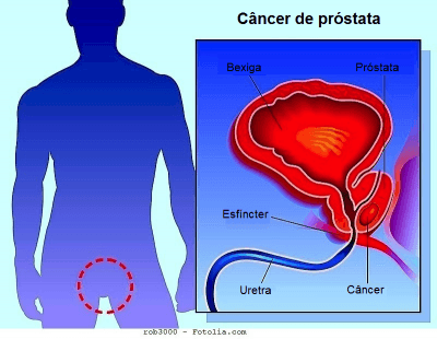 Cancer de prostata sintomas
