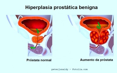 Próstata, hiperplasia, inflamada