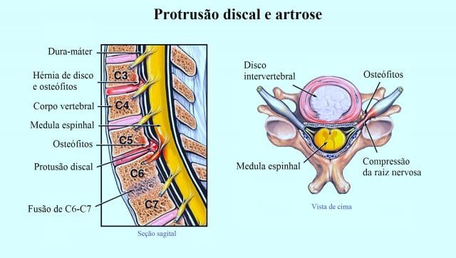 protrusão,discal e artrose