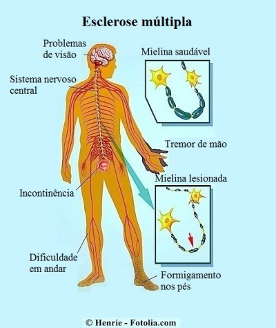 Esclerose múltipla,sintomas