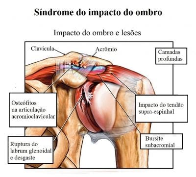 síndrome,do,impacto,do,ombro