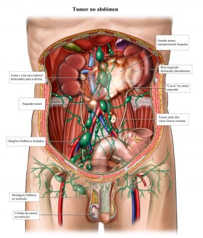 tumor,abdominal,massa,pressão,rim