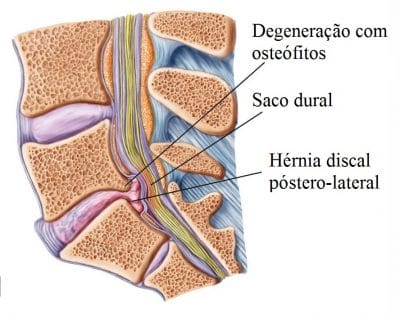 Hérnia,de,disco,com,osteófitos