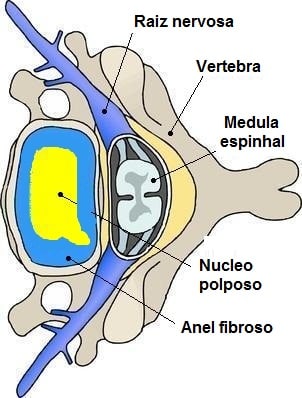abaulamento, disco, hérnia, disco, vértebra, coluna, medula