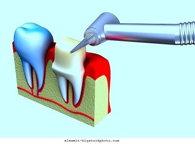 tratamento de canal,dentista,dente