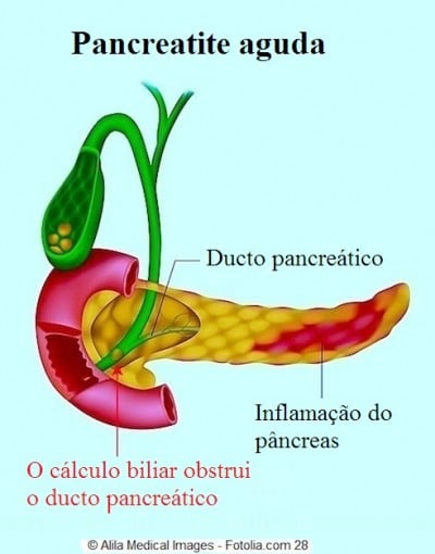 Pâncreas, pancreatite, inflamação e sintomas
