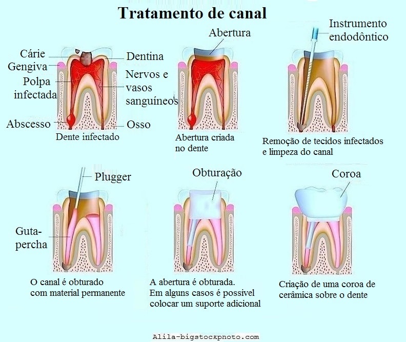 tratamento de canal,dente,obturação,abscesso 