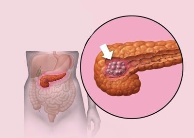 Câncer pancreático