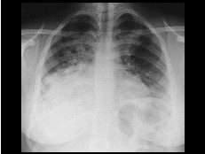 Radiografia, pneumonia