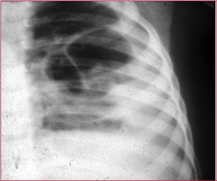 consolidação,pneumonia lobar,radiografia