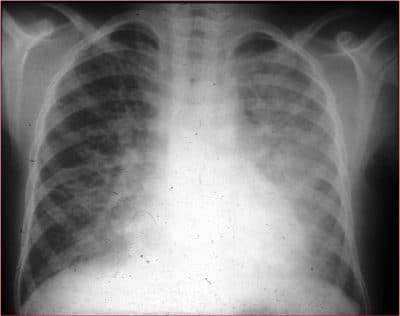 pneumonia intersticial,consolidação,pulmão,direito,esquerdo