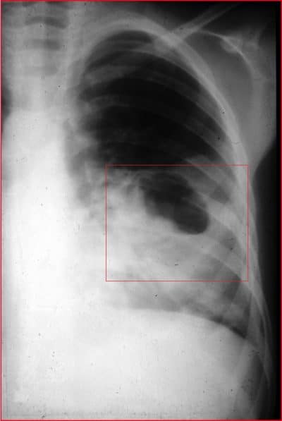 radiografia,necrose,tecido,pulmonar,pneumonia