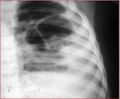 radiografia-pneumonia-lobar