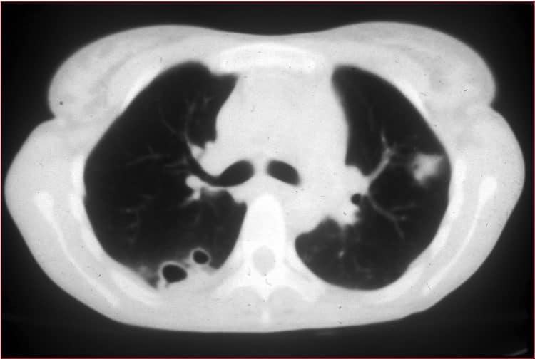 tomografia,pneumonia,Aspergillus-opacidade,consolidação,cavitação
