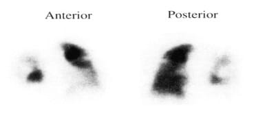 Cintilografia pulmonar, embolia