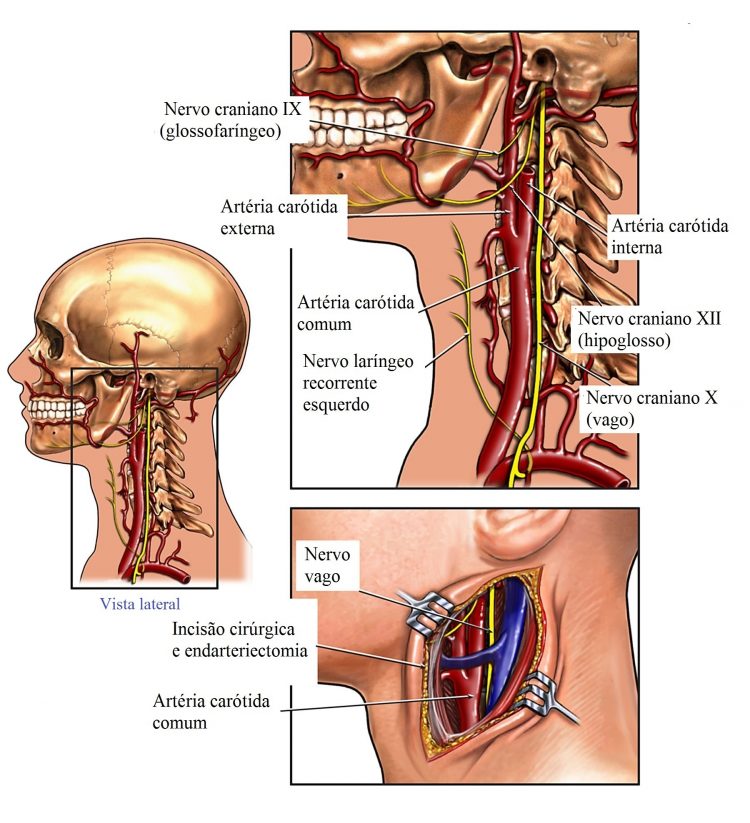 Carotida, arteria, interna, externa