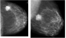 Carcinoma ductal invasivo - mamografia