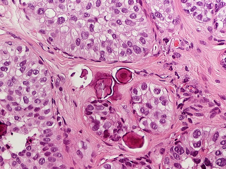 Neoplasia intra-epitelial ductal, grau 2, DIN2