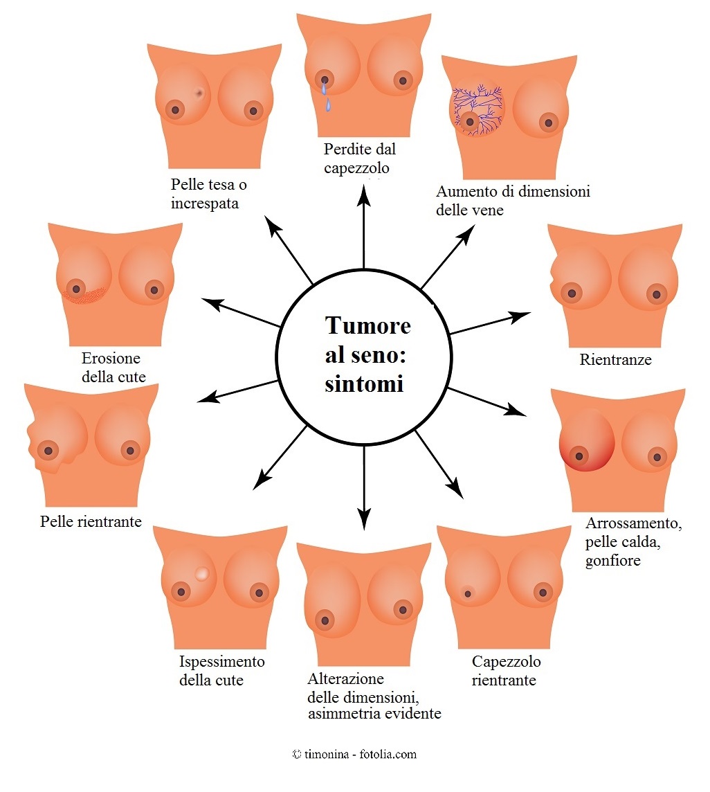 sintomas de câncer de mama maligno