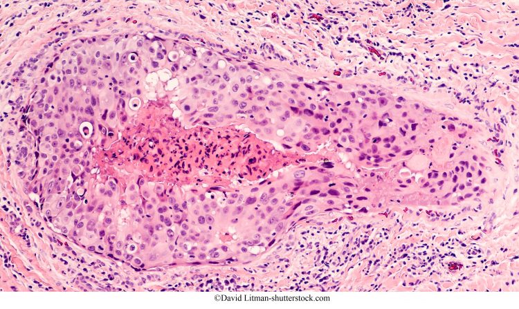biópsia, carcinoma ductal de grau 3, necrose comedônica