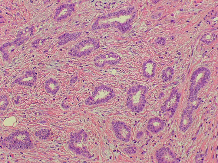 carcinoma ductal G1