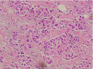 carcinoma ductal,grau 3,nucleo irregular