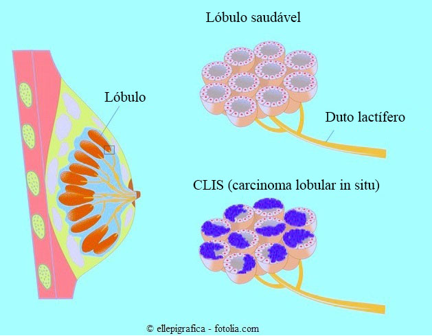 carcinoma lobular
