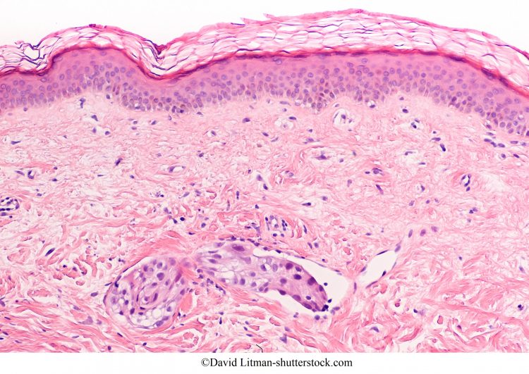 câncer de mama, células cancerosas nos gânglios linfáticos