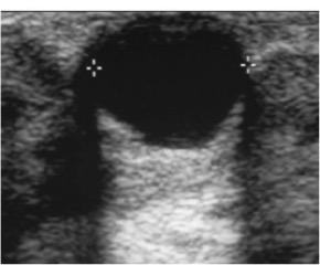 Ultrassonografia da mama,cisto