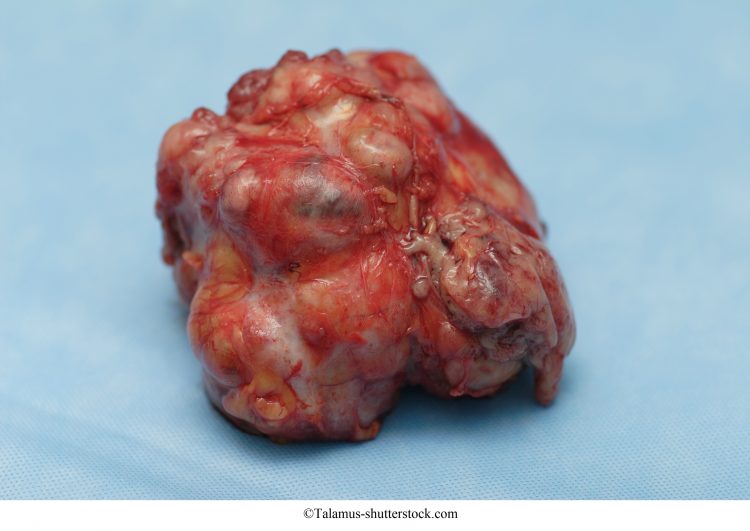 fibroadenoma,grande,tumor,benigno