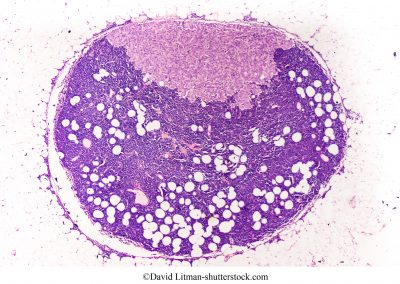 linfonodo sentinela, infiltração de células de carcinoma ductal
