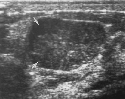 tumor filóide, ultrassonografia