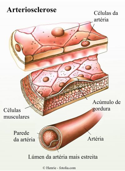 Arteriosclerose