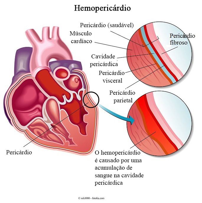 Hemopericárdio